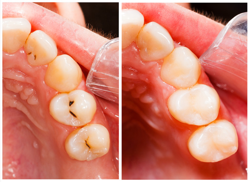 Fillings 6500 Jericho Turnpike, Suite 2W<Br>Syosset, NY 11791