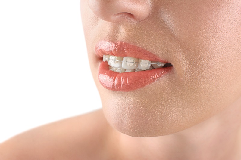 Clear Braces 6500 Jericho Turnpike, Suite 2W<Br>Syosset, NY 11791