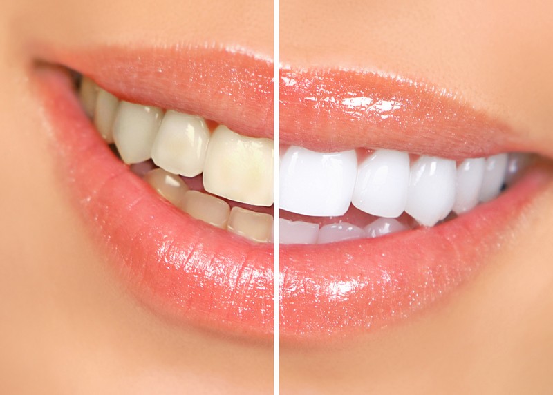 Teeth Whitening 6500 Jericho Turnpike, Suite 2W<Br>Syosset, NY 11791